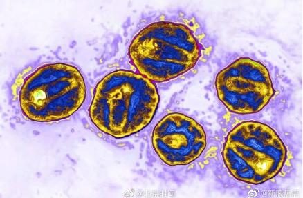 全球第5位艾滋病治愈者出现 首次公布他被成功治疗的细节