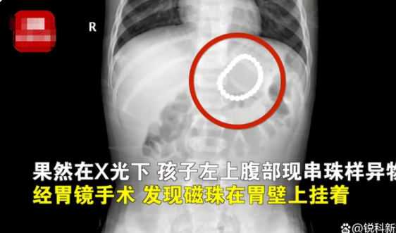 2岁幼童误吞28颗磁力珠 到底怎么回事