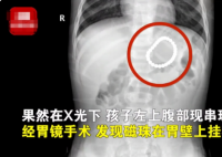 2岁幼童误吞28颗磁力珠 到底怎么回事