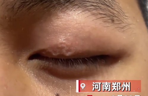 男子左眼皮异常抖动有虫游走 而且还没有什么治疗方法