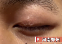 男子左眼皮异常抖动有虫游走 背后真相曝光让人惊愕