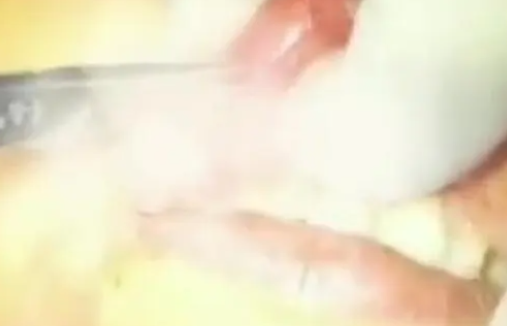 女子摔跤上牙磕进嘴唇1月后才发现 自己感到很吃惊