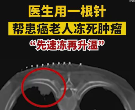 医生用一根针帮患癌老人冻死肿瘤 术后，王大爷痛苦明显减轻，恢复良好。