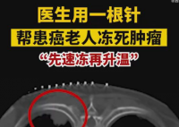 医生用一根针帮患癌老人冻死肿瘤 术后，王大爷痛苦明显减轻，恢复良好。