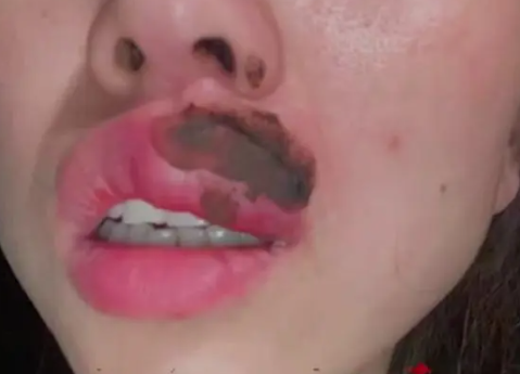 女子睡觉被蜈蚣咬醒 嘴肿成“香肠” 嘴巴马上麻木了
