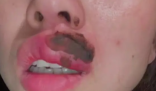女子睡觉被蜈蚣咬醒 嘴肿成“香肠” 嘴巴马上麻木了