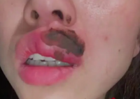 女子睡觉被蜈蚣咬醒 嘴肿成“香肠” 嘴巴马上麻木了