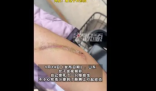 女子捏死隐翅虫手臂被腐蚀7天还没好 缩小变浅要一两个月
