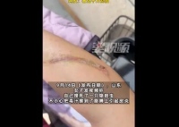 女子捏死隐翅虫手臂被腐蚀7天还没好 缩小变浅要一两个月
