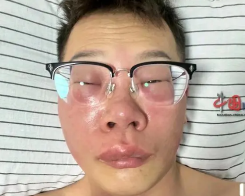 小伙称因长期抠鼻子感染丹毒 要认识到这种行为的危害性