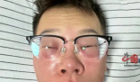 小伙称因长期抠鼻子感染丹毒 导致细菌感染