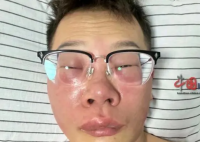 小伙称因长期抠鼻子感染丹毒 要认识到这种行为的危害性