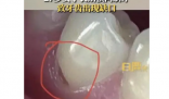 27岁女子长期横向刷牙致牙齿缺损 这让她感到非常震惊和担忧