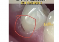 27岁女子长期横向刷牙致牙齿缺损 这让她感到非常震惊和担忧