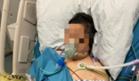 夫妻宰杀活鸭被抓伤住进ICU 如何预防鹦鹉热?